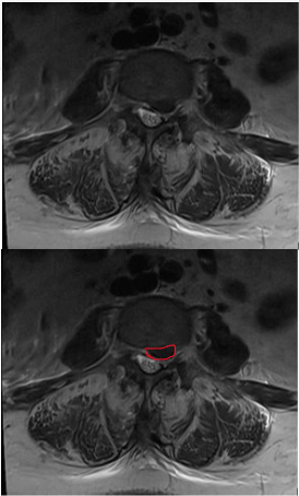 MRI showing a lumbar disk herniation, outlined in red on the right 
