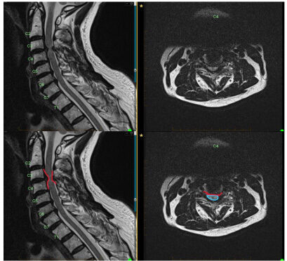 MRI of cervical disk herniation and compression. The compression is outlined in red on the bottom left image and the disk herniation causing compression is outlined in red on the right image with the spinal cord compression outlined in blue .