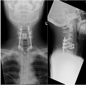 Posterior fusion and laminectomy with ACDF 