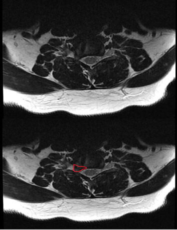 MRI showing cervical disk herniation pressing on a nerve root (outlined in red on right picture)  