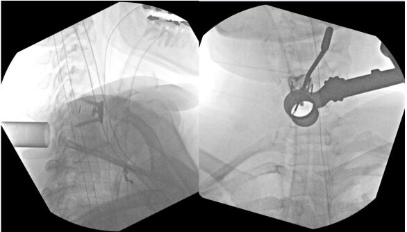 X-ray during surgery that shows the MIS tubular retractor used to access the back of the cervical spine to minimize incision size and tissue disruption.  