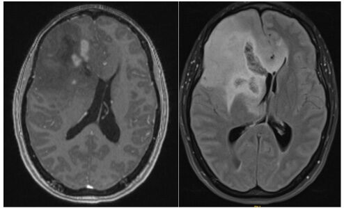 Different MRI sequences showing an extensive right frontal Grade 3 oligodendroglioma 