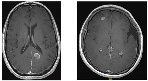 Image 1 (left): MRI of a grade IV glioma in the left occipital lobe  Image 2 (right): MRI showing Grade I pilocytic astrocytoma in the right frontal lobe  