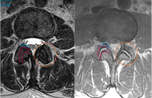 MRI of the spine without (left) and with (right) age-related changes in the joint (orange circle). The red outline is the space between the joints. Notice how on the left image, there is less white and less space between the two lines, while on the right, there is more white and more space. This is evidence of increased joint fluid and inflammation. The blue line on each image highlights the yellow ligament, which gets thicker with joint inflammation and stress. These changes are common as people age, but can cause pain in some patients.  