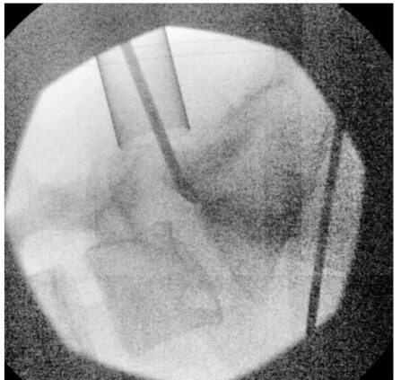 X-ray during surgery using MIS tubular retractor for microdiskectomy 