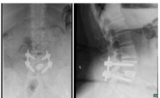 X-rays showing the same patient after a minimally invasive transforaminal lumbar interbody fusion (MIS-TLIF). The prior step-off of the spine is corrected. 