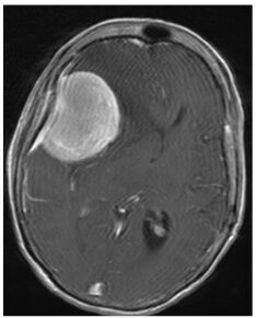 MRI of large right frontotemporal meningioma causing severe brain compression 