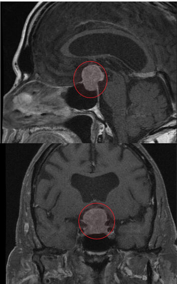 MRI of pituitary macroadenoma circled in red 