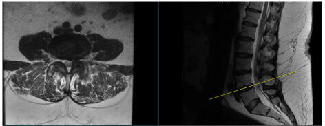 MRI showing compression of the nerves at the L4/5 level in same patient as x-rays. Notice on the MRI the step-off in the spine is gone. When the patient stands, the nerve compression gets worse because the spine slips forward. 